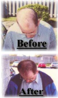 Hair Loss Treatment Demonstration